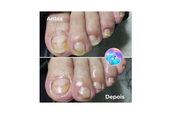 Foto de antes e depois do tratamento 45